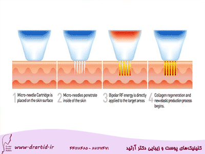 RF نیدلینگ فرکشنال
