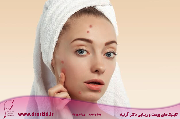 closeup young woman with towel head pimples face 273609 14431 - انواع پوست و چگونگی تشخیص هریک از انواع آن