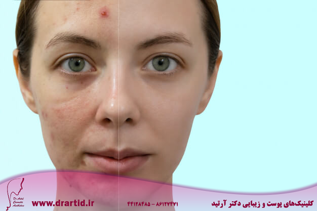 comparison portrait woman with problematic skin without with makeup 122525 353 - انواع پوست و چگونگی تشخیص هریک از انواع آن
