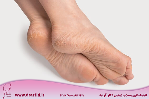 dry cracked soles feet female legs feet foot elegant position dry skin heels soles 256259 910 - انواع پوست و چگونگی تشخیص هریک از انواع آن