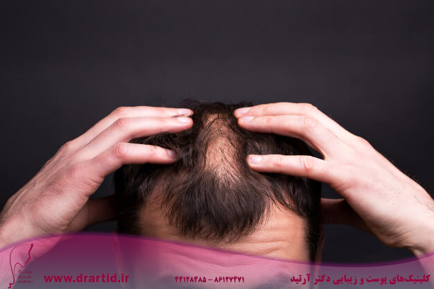 men with bald head black wall close up 120739 761 - فیلر مو انقلابی جهت تقویت مو و بهبود ریزش آن
