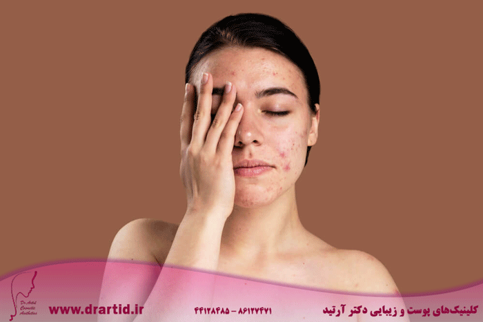 portrait young woman being confident with her acne 1 - چرا فشیال مهم است؟!