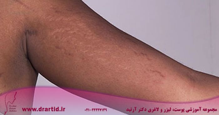 ds01081 im00022 sn7 stretchmarks2thu jpg - کشیدگی پوست (استرچ مارک) چیست و چه راه‌های درمانی برای آن وجود دارد؟