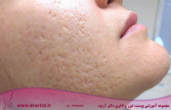 anti open pores facial treatment 500x500 1 - چگونه از شر منافذ باز پوست خلاص شویم؟