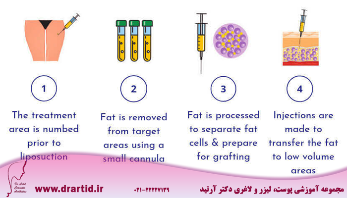 fat transfer process - پیوند نانو چربی (تزریق چربی) چیست؟