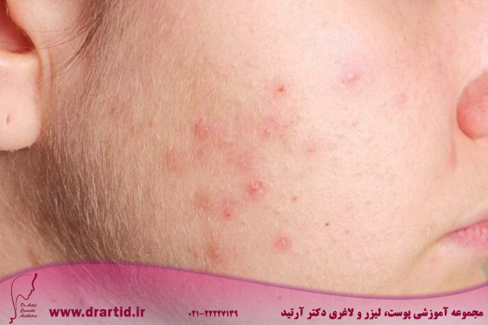02 cheeks What The Acne On Every Part Of Your Body Is Trying To Tell You 385615111 TRIG 760x506 1 - آکنه و روش‌های درمان آن