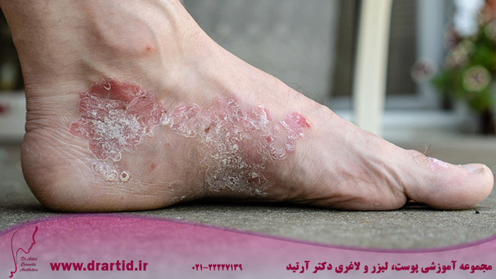 EczemaOrPsoriasis Web 960x540 - هر آنچه باید در مورد بیماری پوستی پسوریازیس بدانید!
