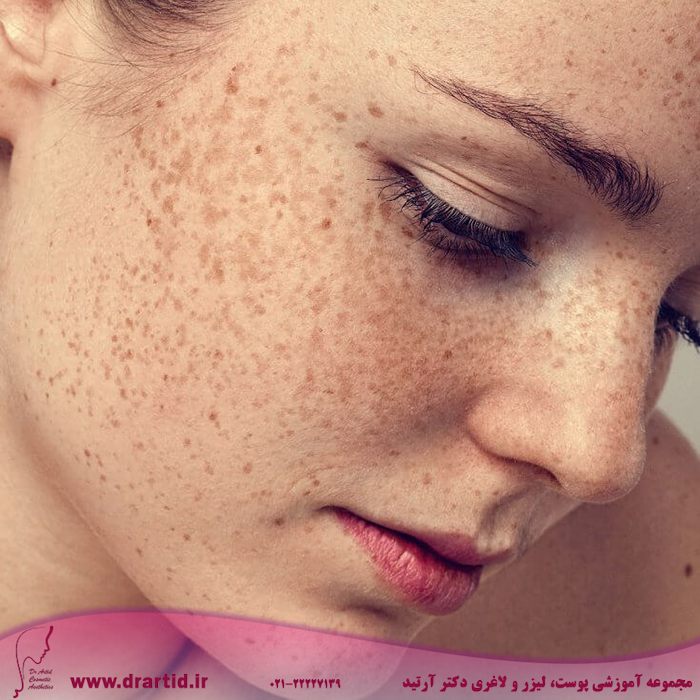 Hyperpigmentation THUMBNAIL - انواع لک‌های پوستی و چگونگی خلاص شدن از آن‌ها