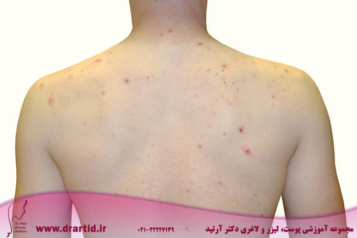 content typical body acne boy upper back acne - آکنه و روش‌های درمان آن