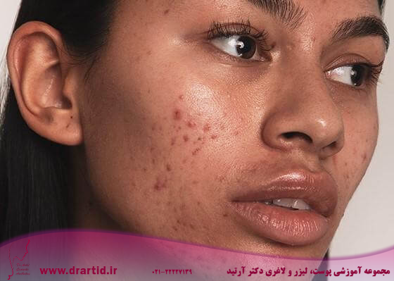 hyperpigmentation of skin 345x@2x - انواع لک‌های پوستی و چگونگی خلاص شدن از آن‌ها