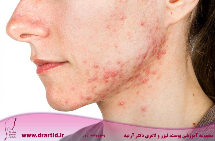 person with acne - آکنه و روش‌های درمان آن