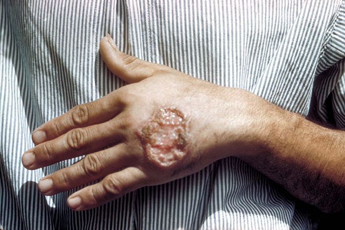 Skin ulcer due to leishmaniasis hand of Central American adult 3MG0037 lores - مقالات