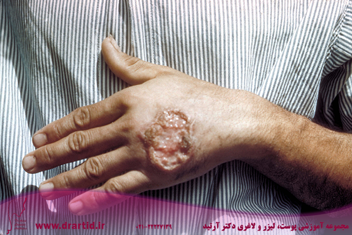 Skin ulcer due to leishmaniasis hand of Central American adult 3MG0037 lores - هرآنچه باید در مورد بیماری پوستی سالک بدانید!