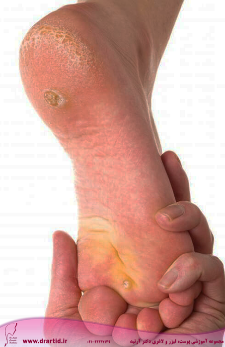 close view of warts on foot - میخچه و پینه و راه‌های پیشگیری از آن‌ها