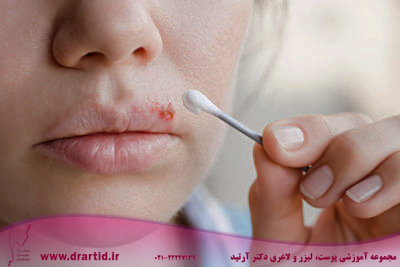 cold sores a major oral herpes symptom e1538964547246 - چرا به تبخال یا تاول تب دچار می‌شویم؟!