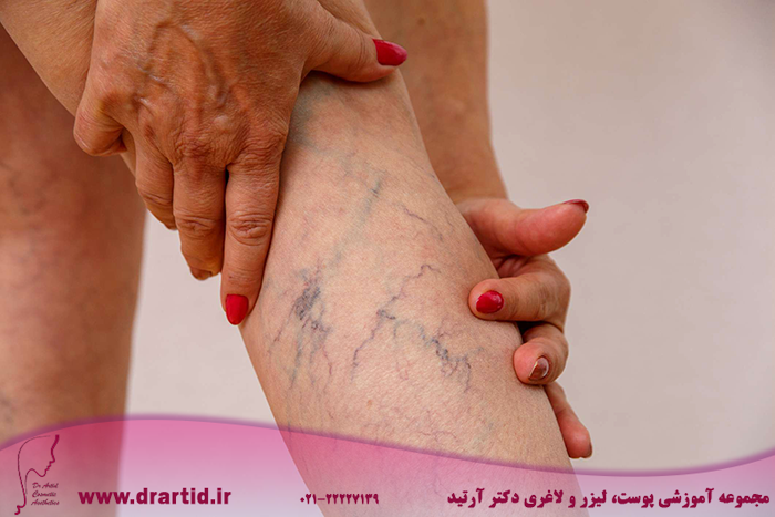 elderly woman shows varicose 1145186766 cfb1326c1dac4189bbc78ca19847128b - واریس چیست و چگونه درمان می‌شود؟