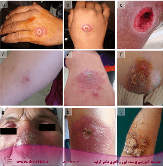 fig1 - هرآنچه باید در مورد بیماری پوستی سالک بدانید!