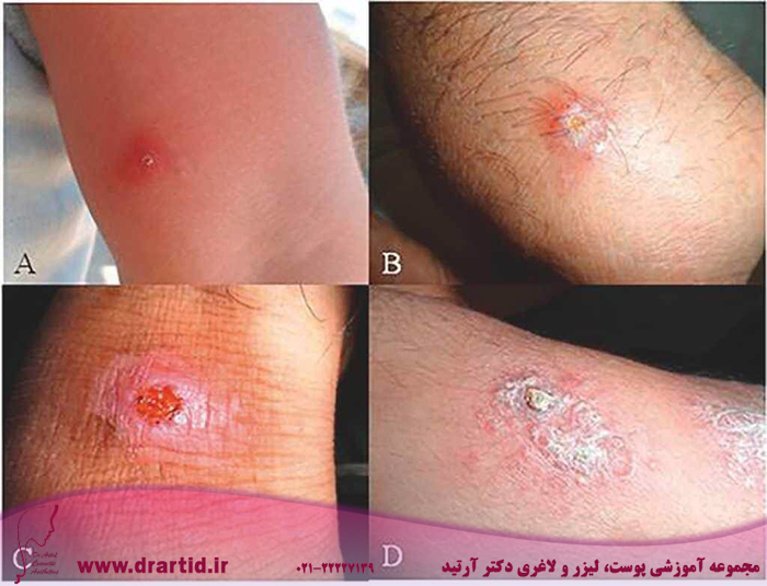 gr1 - هرآنچه باید در مورد بیماری پوستی سالک بدانید!