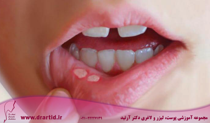 cancer sore fi11738656 - آفت دهان چیست و چرا ایجاد می‌شود؟!