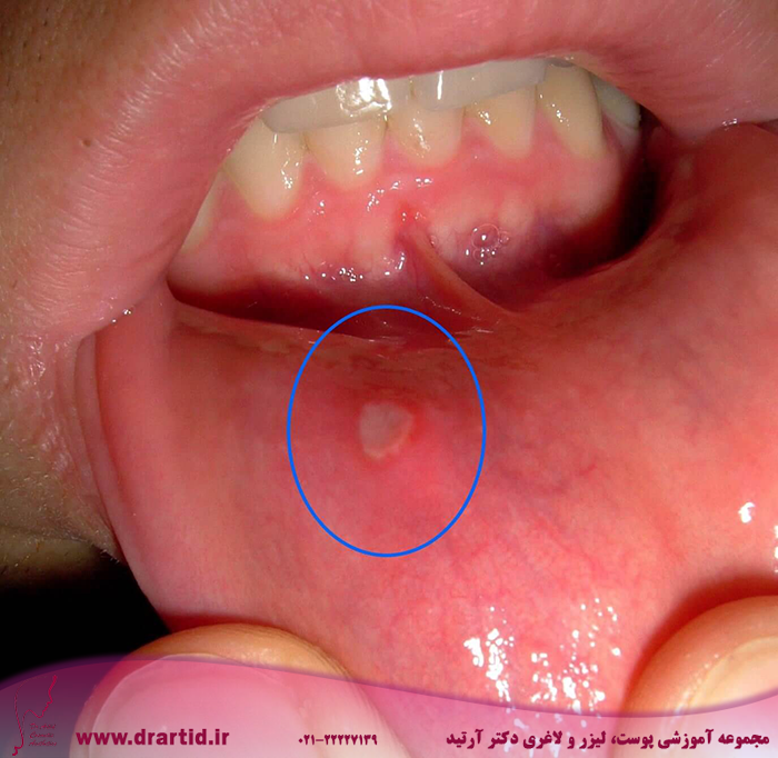 canker sore prevention and causes - آفت دهان چیست و چرا ایجاد می‌شود؟!