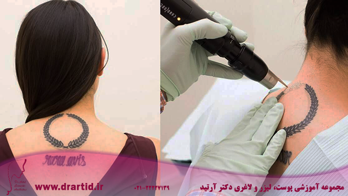 lauren chan tattoo removal - آیا لیزر پاک کننده تتو واقعا در پاک کردن تتو موثر است؟