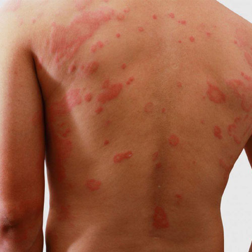 عکس بثورات پوستی + عکس بیماری های پوستی + عکس زخم های پوستی