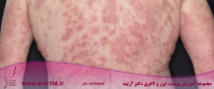 13357150 HiRes Atopic dermatitis - هر آنچه باید در مورد بیماری درماتیت آتوپیک بدانید!