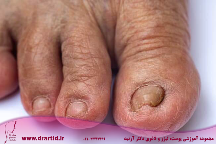 1800ss getty rf toenails - علت ترک خوردن ناخن چیست؟چگونه آن را درمان کنیم؟