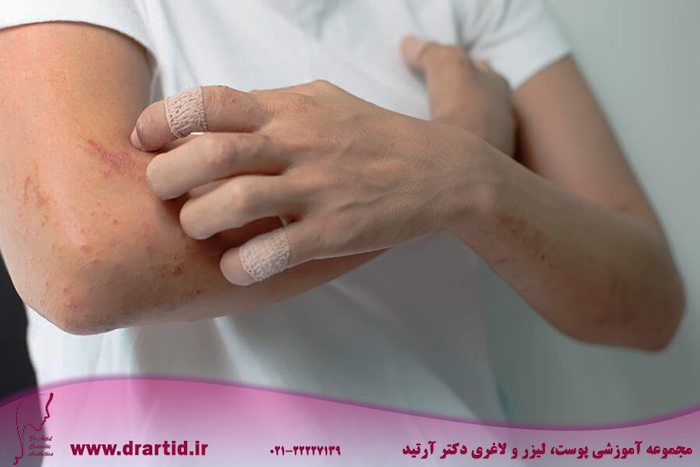 Adult Atopic Dermatitis Eczema of Grown Ups - هر آنچه باید در مورد بیماری درماتیت آتوپیک بدانید!
