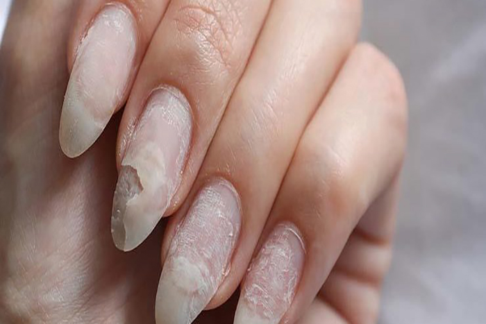 Broken and brittle nails Here are the causes symptoms and 740x375 1 - مقالات