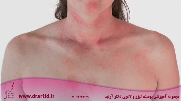 atopic dermatitis neck - هر آنچه باید در مورد بیماری درماتیت آتوپیک بدانید!