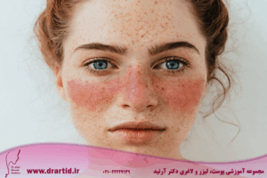 آرتروز پسوریاتیک در مقایسه با لوپوس: چه تفاوت‌هایی باهم دارند؟