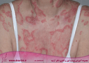 آرتروز پسوریاتیک در مقایسه با لوپوس: چه تفاوت‌هایی باهم دارند؟