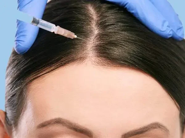 meditravelist_mesotheraphy-for-hair مزو مو
